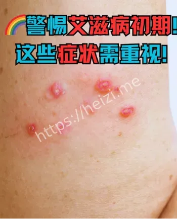 艾滋病疫情