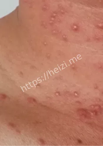 疫苗研究突破