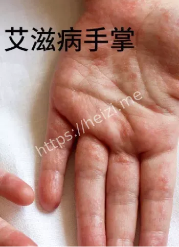 防艾宣传