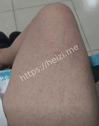 患者症状