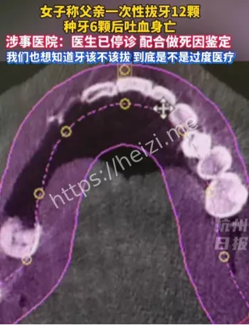 拔牙23颗