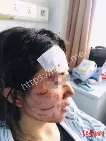 毁容事件