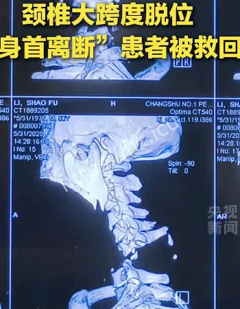 缝合身首离断
